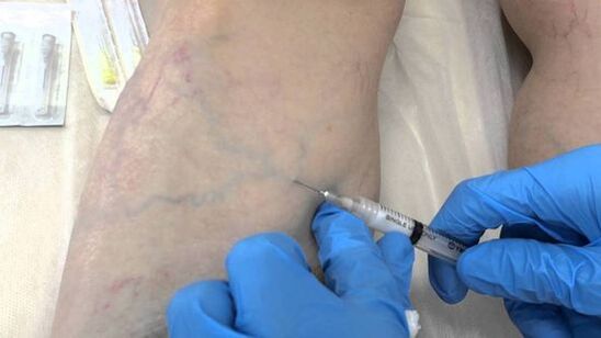 Scleroterapia pentru vene varicoase de pe picioare la femei