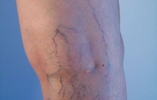 Vene varicoase pe picioare la femei