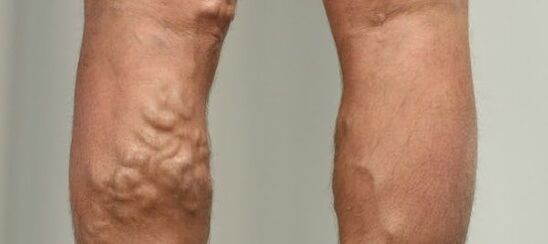 Vene varicoase pe picior