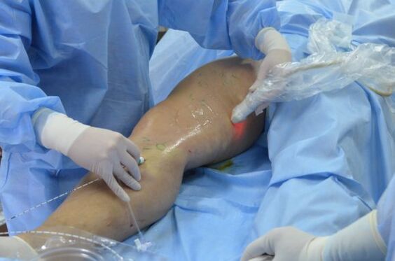 Chirurgie pentru îndepărtarea venelor varicoase laterale