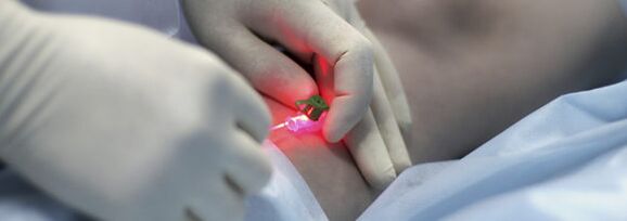 Îndepărtarea unei vene din picior folosind coagularea cu laser