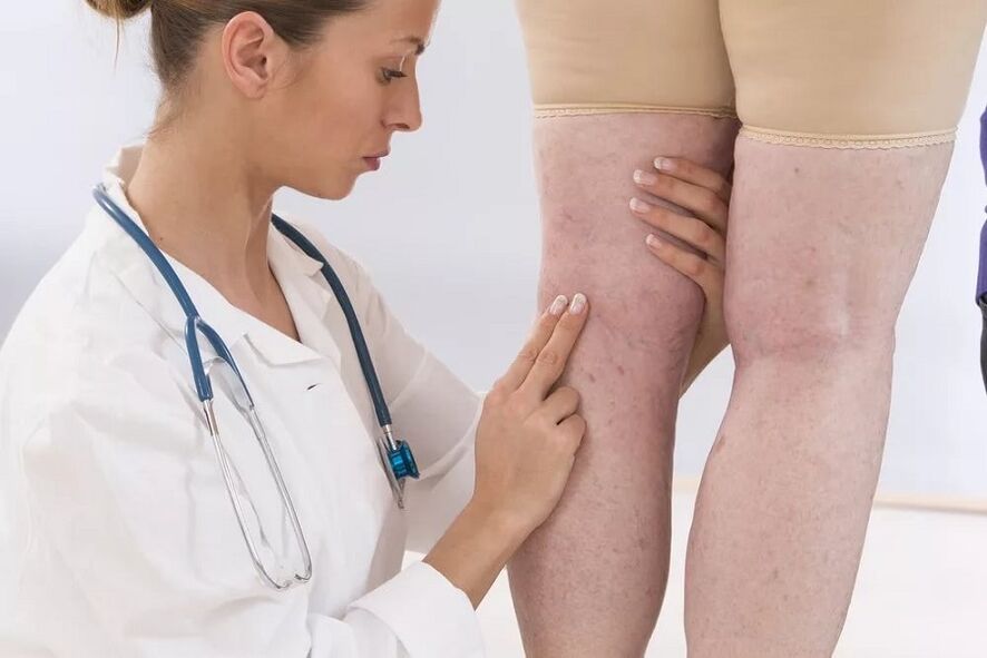 Medicul examinează venele pentru varice